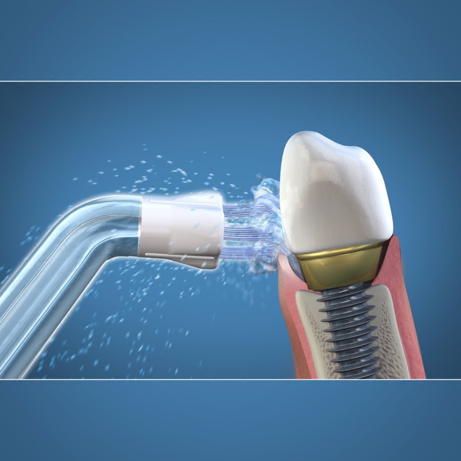 Насадки на ирригатор Waterpik для имплантов